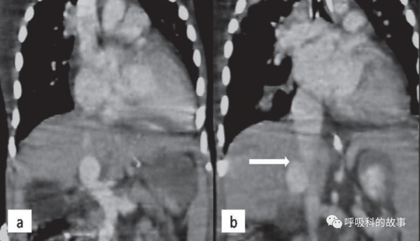 貌似心衰非心衰 低氧血癥從何而來 類肝硬化無硬化 門脈高壓如何演變