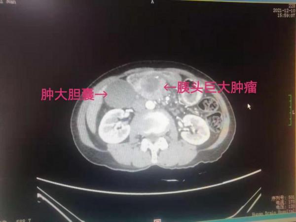 湖南省第二人民醫院：“登珠峰”不再難！順利完成高難度手術