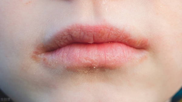 舌舔唇炎，嘴唇紅腫疼痛乾裂，你得這麼治療，才能避免慢性化