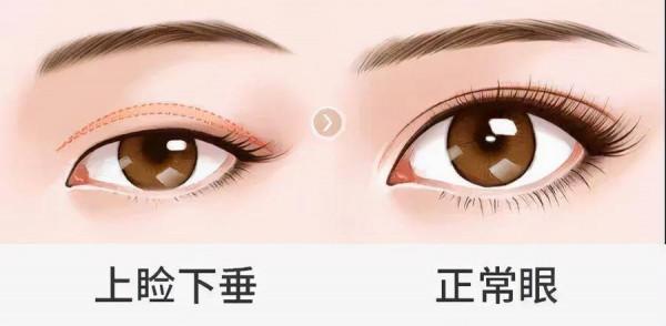 上瞼提肌是什麼？上眼瞼肌無力怎麼辦？