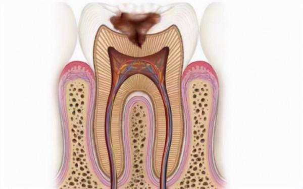 出現牙疼疼痛難忍,千萬不能小視,可能是牙髓炎 出現牙疼疼痛難忍,千萬不能小視,可能是牙髓炎