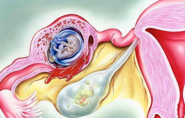 全球不足30例!廣西一女子懷孕,胎兒卻長在肝臟裡,能生下來嗎? 全球不足30例!廣西一女子懷孕,胎兒卻長在肝臟裡,能生下來嗎?