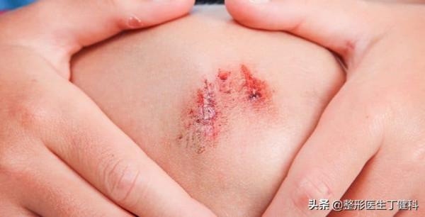 面板擦傷不用慌,這樣處理瘢痕最小 面板擦傷不用慌,這樣處理瘢痕最小