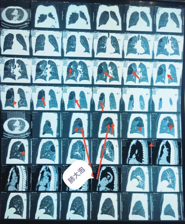 肺大泡相關（診治）問題