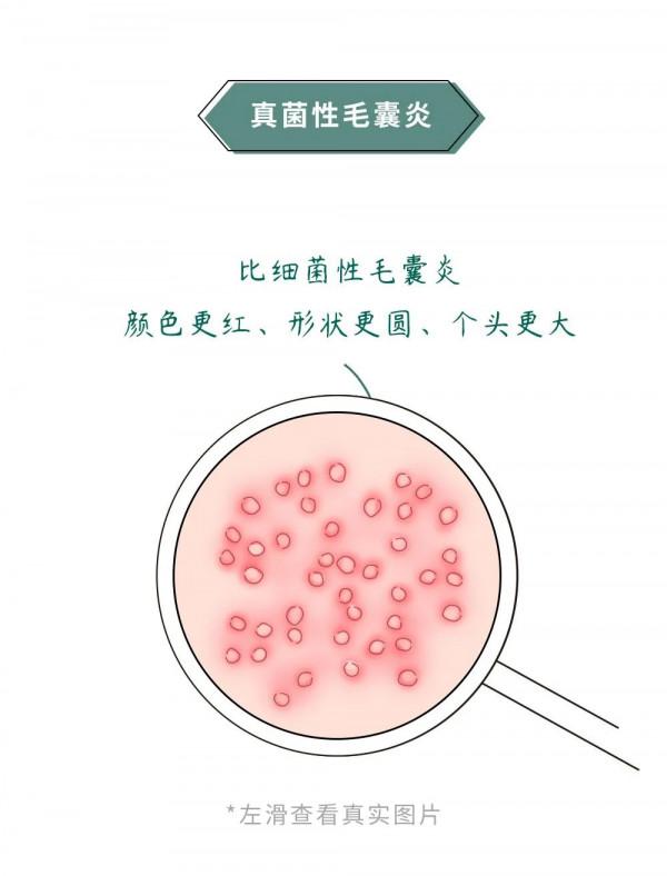 漫畫科普：“揹負”太多，“疹”的很累！