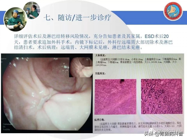 早期胃癌——內鏡診治流程