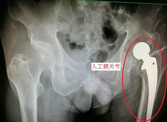 股骨頸骨折後的治療方案