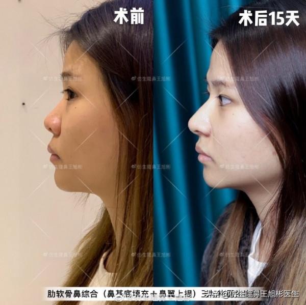 鼻頭縮小可以只“減脂”，不取自體軟骨做支架嗎？