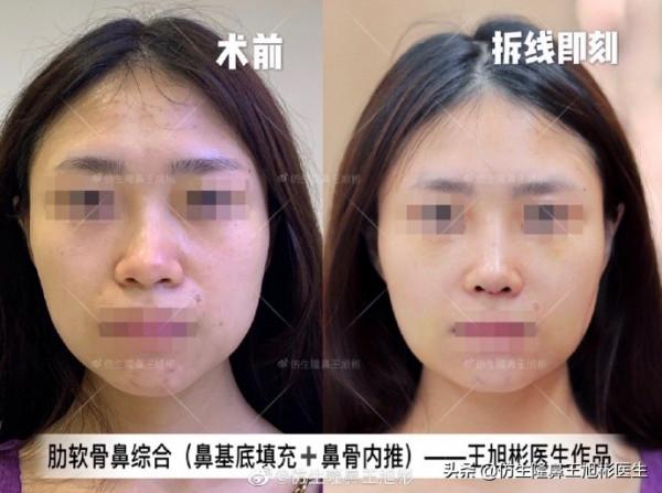 鼻頭縮小可以只“減脂”，不取自體軟骨做支架嗎？