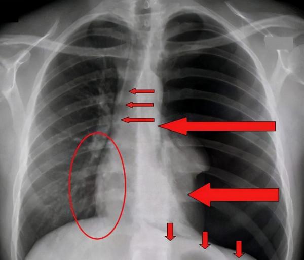 一高校男生連輸22場排位賽,胸痛緊急入院,醫生:肺氣擴張很危險 一高校男生連輸22場排位賽,胸痛緊急入院,醫生:肺氣擴張很危險