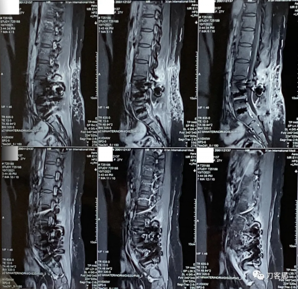 27歲女性，兩間隙腰椎間盤突出症，6顆釘子，4個融合器
