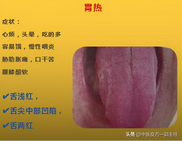 12種“熱”藏於體內,反應的舌象、症狀各不相同,自查便知 12種“熱”藏於體內,反應的舌象、症狀各不相同,自查便知