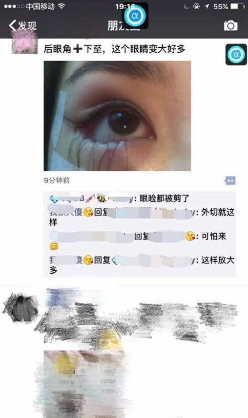 下三白眼科普：下瞼下至注意分寸！別過度醫療，錯把病態當美態