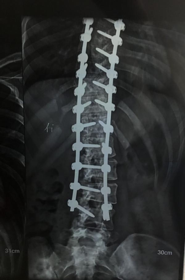 22根鋼釘+折斷3根肋骨，是我變“直”的代價