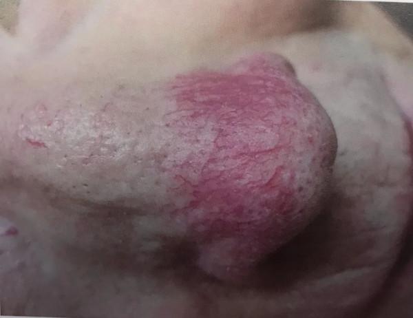 玫瑰痤瘡能治好嗎?該怎麼治? 玫瑰痤瘡能治好嗎?該怎麼治?