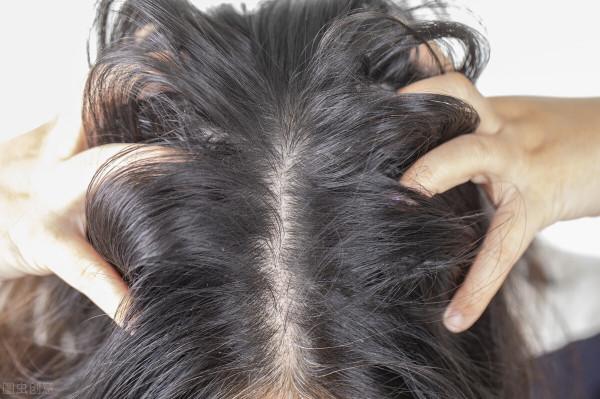 你的頭也經常癢，上午洗頭下午就油了？這可能是頭皮炎症