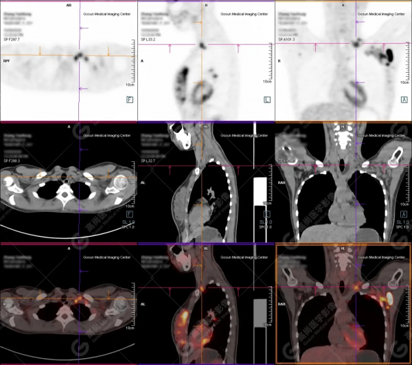 PET/CT病例（3）：別因害羞不願就診而延誤診斷——青年乳腺癌