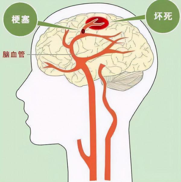 中老年釣魚者注意了，冬季中風高發，做好這4點，更好遠離疾病