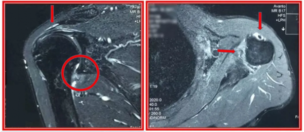 長在肩膀上的“結石”:6旬阿姨肩膀半夜痛醒誤以為肩周炎,原來是肩袖鈣化性肌腱炎 長在肩膀上的“結石”:6旬阿姨肩膀半夜痛醒誤以為肩周炎,原來是肩袖鈣化性肌腱炎