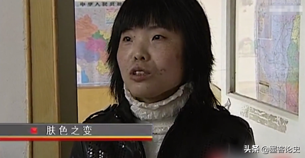 真實故事:山西45歲女子一夜變黑,體重急速增加,手術後讓家人落淚