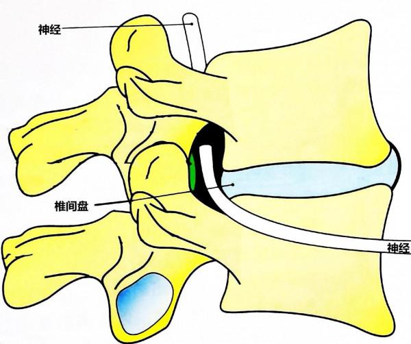 燕飛式-腰部後伸鍛鍊方式的缺陷