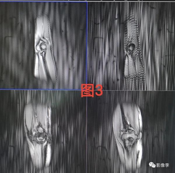 “靜電”與磁共振成像：秋冬季節注意