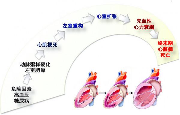 心室肥厚、心臟擴大、心力衰竭，高血壓下的心臟都經歷了什麼？