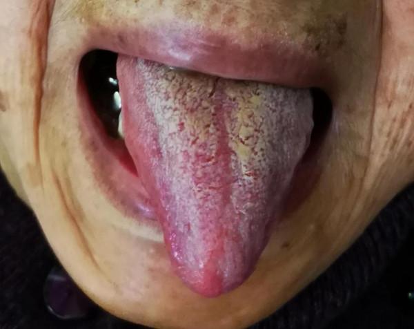 我是如何根據中風先兆脈象辨治這例頭痛病例的