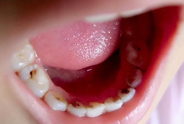 面對孩子的蛀牙，您考慮過&OpenCurlyDoubleQuote;塗氟&rdquo;嗎？