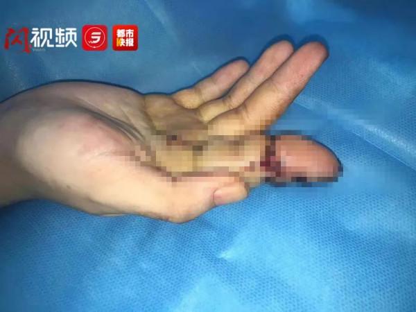 家長警惕!一根線頭令女嬰不幸截肢,20年後醫生為她再造手指 家長警惕!一根線頭令女嬰不幸截肢,20年後醫生為她再造手指