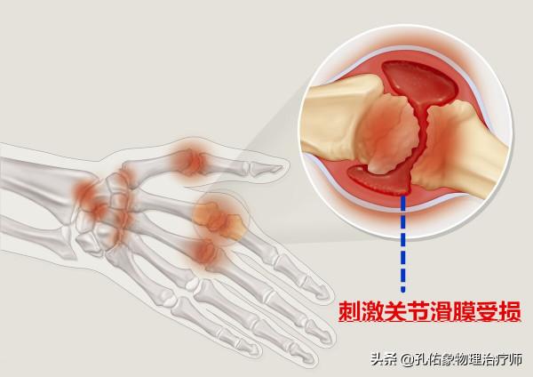 手指發脹、僵硬、握不攏，是風溼嗎？不出意外，這4種可能性較大