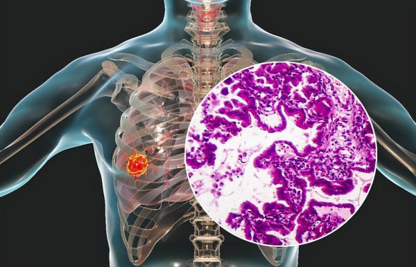 肺部若是出現結節，建議：做好3件事，或能幫你消散結節