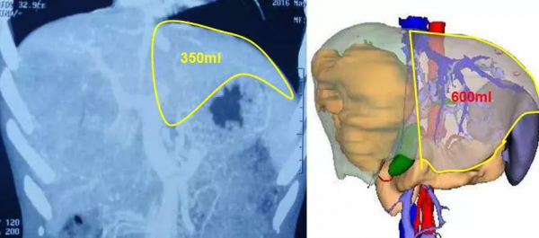 肝癌5年等來了醫學的進步，他說：人在，日子就會越來越好