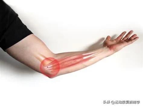 高爾夫球肘的運動康復