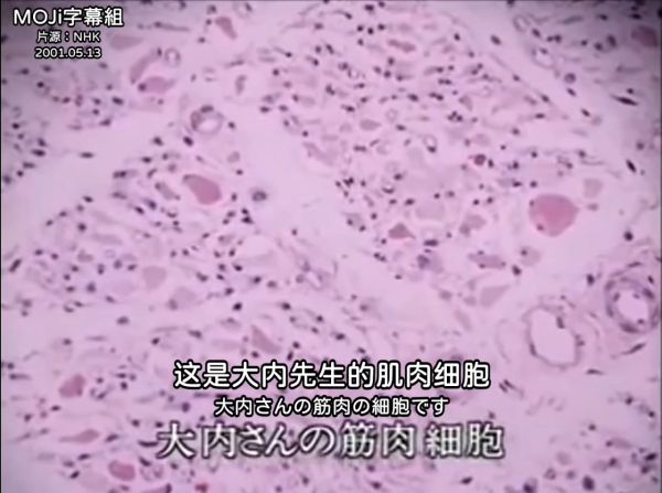 遭受核輻射的人體會有什麼變化?他堅持了83天,最後變成什麼樣了 遭受核輻射的人體會有什麼變化?他堅持了83天,最後變成什麼樣了