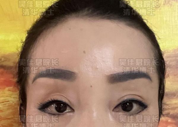額頭提升後的她們，沒了抬頭紋、川字紋，眼睛也更有神了