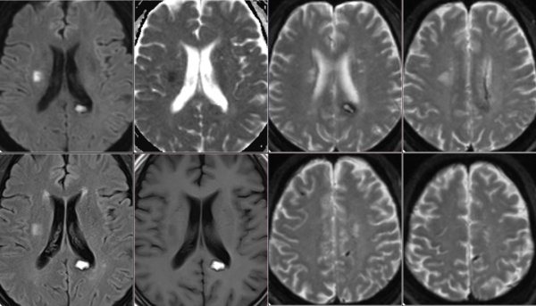 腦動靜脈畸形影像學特徵