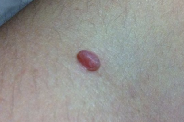 面板上的小肉球、小肉疙瘩是什麼？7種可能，情況有好有壞