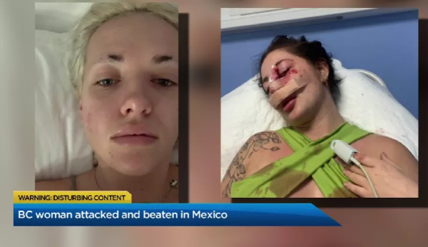 溫哥華美女旅遊勝地遭人痛毆毀容 險些癱瘓 施暴者竟是加拿大老鄉 溫哥華美女旅遊勝地遭人痛毆毀容 險些癱瘓 施暴者竟是加拿大老鄉