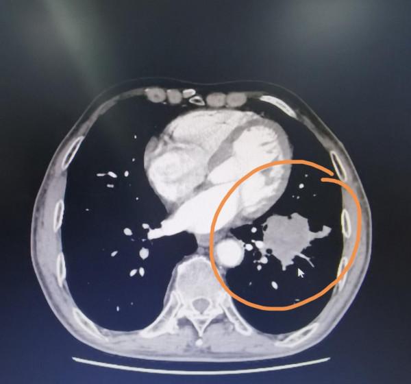 劉懿博士說肺癌（三〇六亖）幹農活手臂疼，住院檢查疑似晚期肺癌