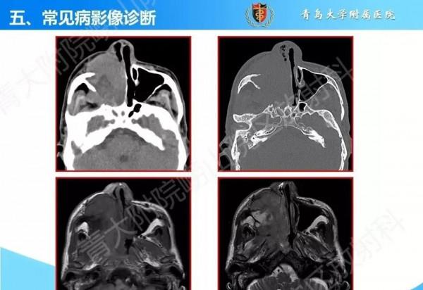 頭頸五官CT斷層解剖圖及常見病影像診斷