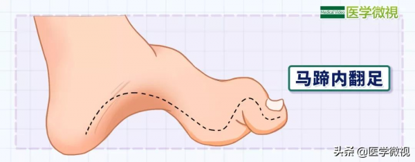 1萬人中有4人，小腿會悄悄變“瘦”，但希望不是你