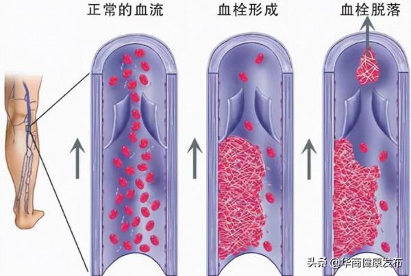 一次跑步差點兒要了28歲小夥的命...