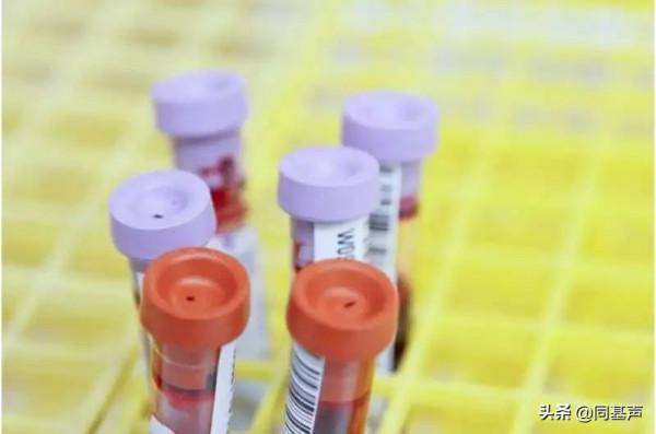 臍帶血治療HIV，可能比過去的治療方法併發症少