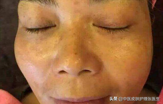 色斑是如何形成的？我的臉上是那哪種色斑？張醫生一次給你講清