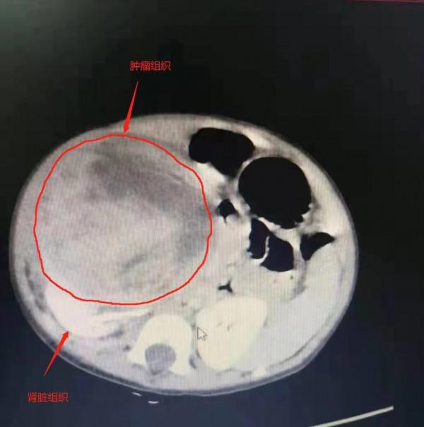 10個月大嬰兒竟長出“第三個腎”，醫生：家長不必過度恐慌，科學治療可實現康復