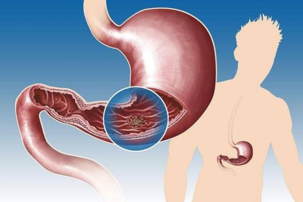 醫生提醒：奧美拉唑在這3種情況下才需要用，別再亂吃了