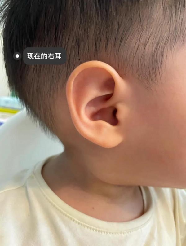 寶寶剛出生耳廓畸形,現在長成什麼樣了? 寶寶剛出生耳廓畸形,現在長成什麼樣了?