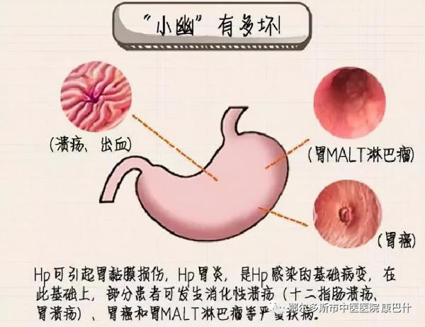 科普 | 診斷早期胃癌的利器——胃功能三項