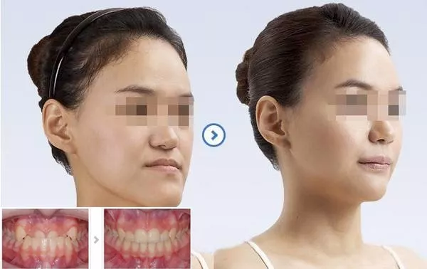 小仙女告訴你，改變牙齒真的可以改變臉型